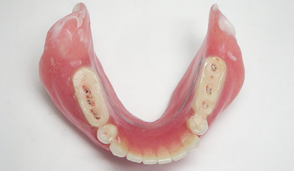 診断用義歯