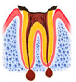 歯根嚢胞